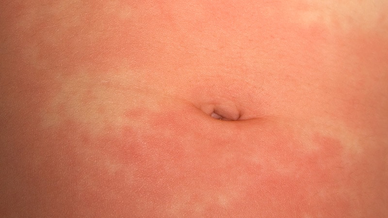 Hives On Child S Stomach