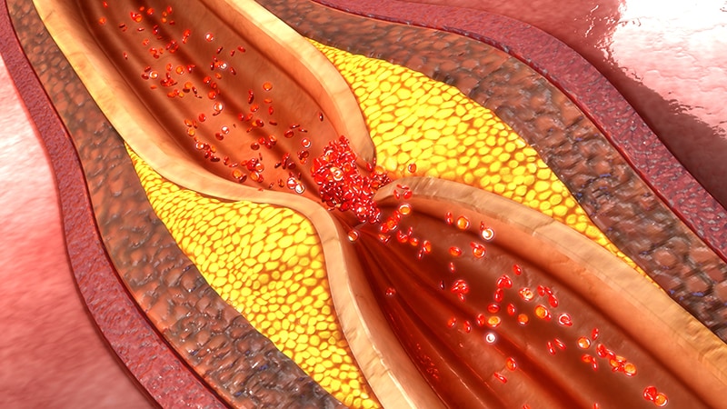 Fast Five Quiz: Coronary Artery Atherosclerosis