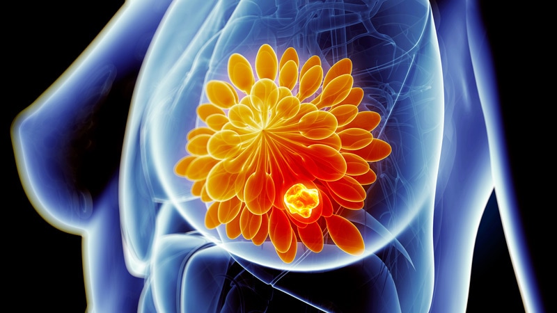 Les statines après le diagnostic peuvent protéger de la mortalité par cancer du sein