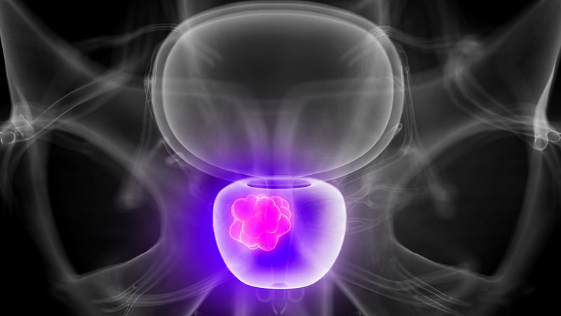 metastatic prostate cancer medscape
