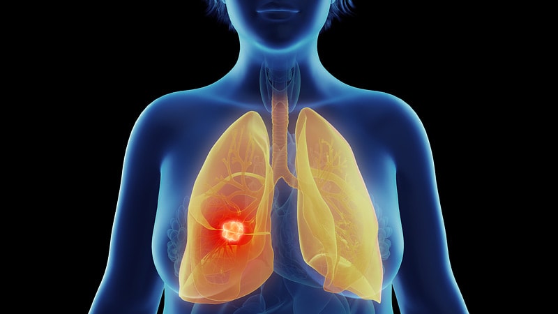 Uptick in Lung Cancer in Younger Women, Not Related to Smoking