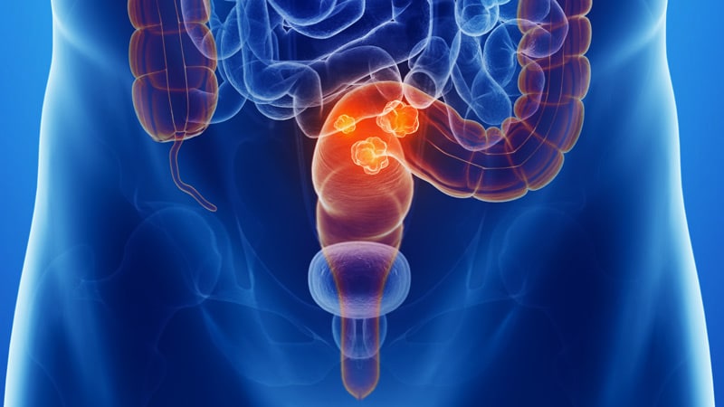 new research in rectal cancer