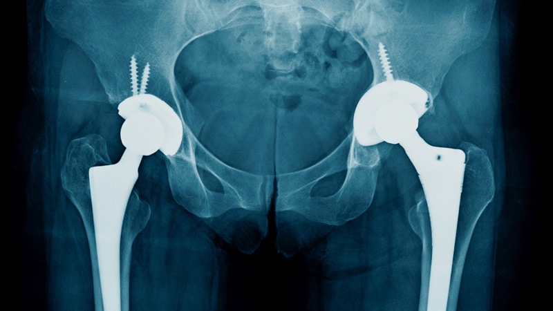 Surgical Approach Tied to Risk in Hip Replacement