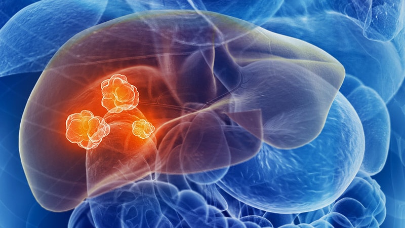 L’ajout de SBRT au sorafenib stimule la survie dans le cancer du foie