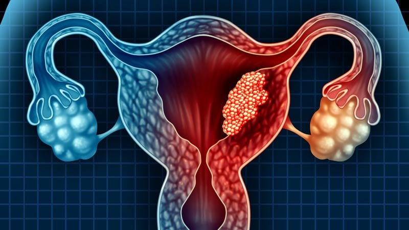 endometrial cancer medscape