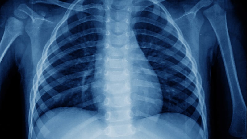 Chest Imaging Guidelines Released for Pediatric COVID-19