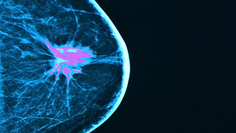 Avantages à long terme de l’adjuvant Abemaciclib dans le cancer du sein