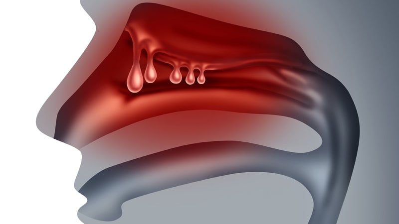 De nombreux patients atteints de polypes nasaux ont arrêté le dupilumab dans une petite étude