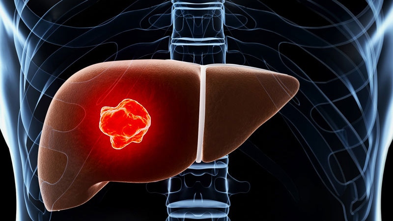  Momentous Data For First Line Combo In Liver Cancer