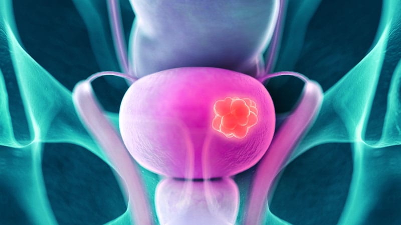 Moving On Up Maintenance Therapy Extends Os In Bladder Cancer