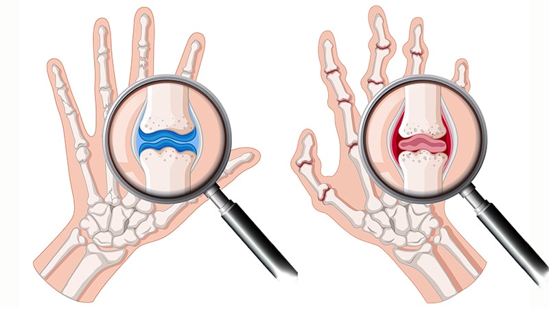 rheumatoid arthritis medscape