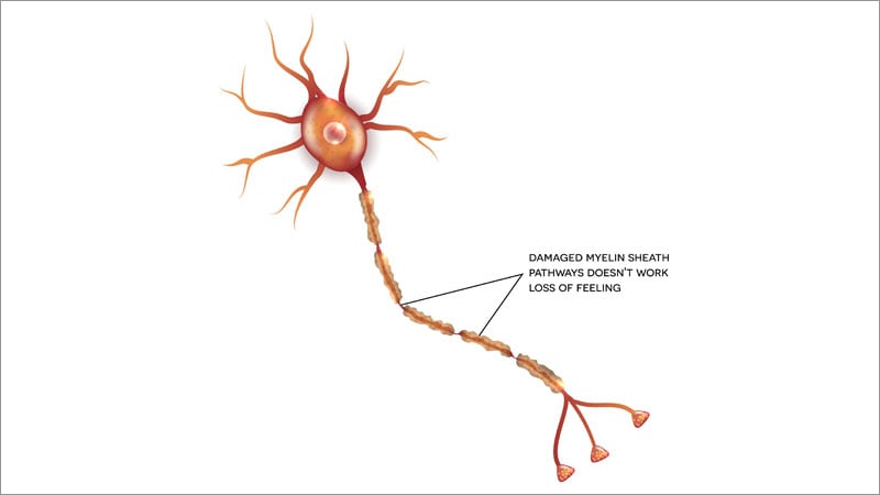 small-fiber-polyneuropathy-may-underlie-dysautonomia-in-me-cfs