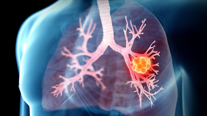 First Drug for MET+ NSCLC Shows High Response Rates