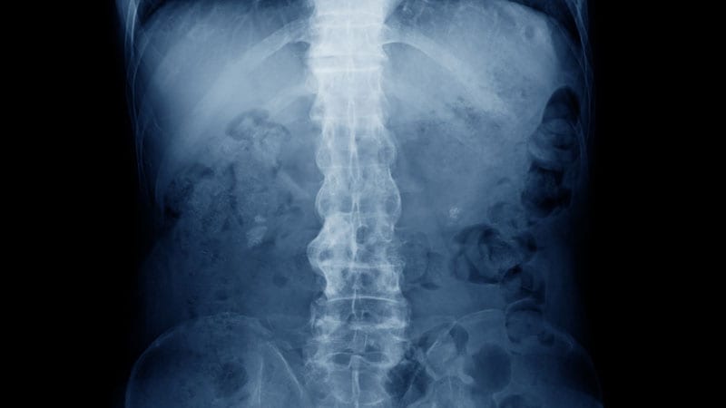 Two Biologics Show No Difference in Axial Spondyloarthritis