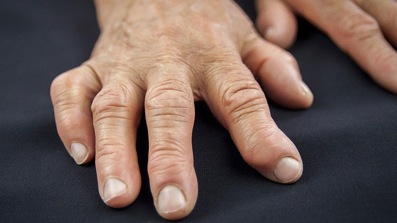 Rheumatoid arthritis medscape workup