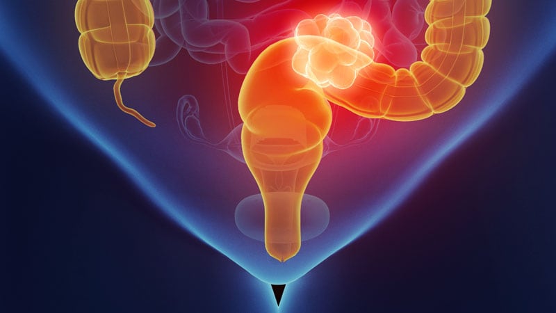 Imaging Cuts Anastomotic Leakage In Rectal Cancer Surgery Medmds 0927