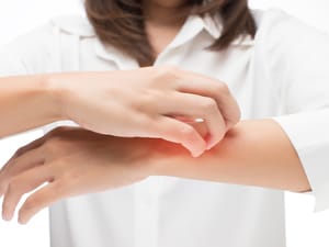 Longer Omalizumab Use Eases Itch From Chronic Hives