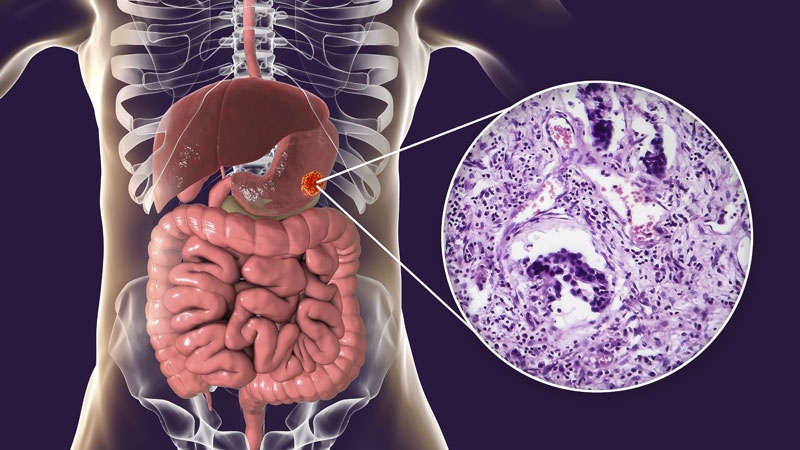 Gastric cancer medscape, 5x5 Rectal Cancer Treatment Protocol - Q&A se vindeca cancerul de colon