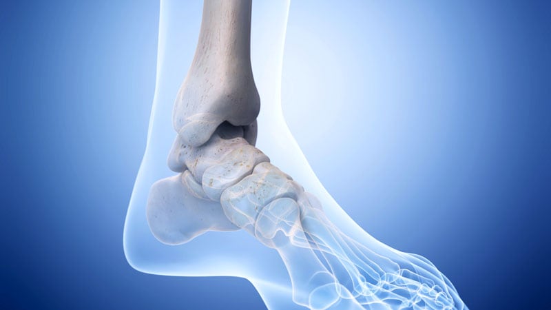 FDA Warns of STAR Ankle Implant Failures