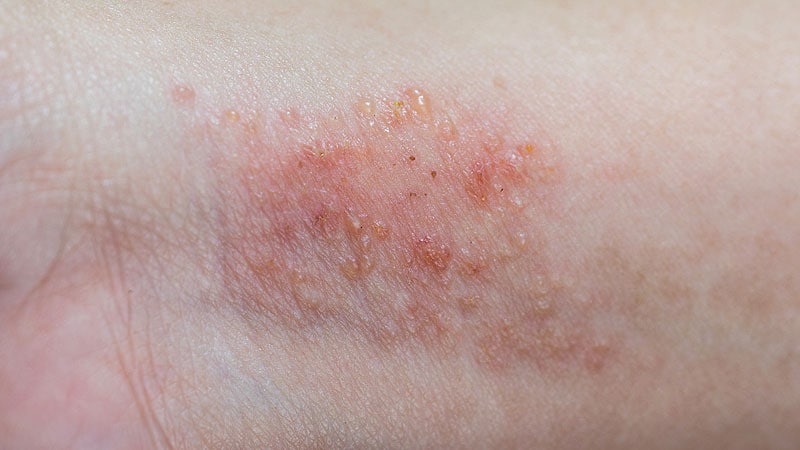 Atopic Dermatitis Can Be Especially Burdensome in the Elderly