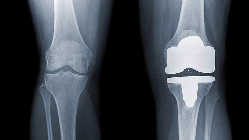 Knee Replacement: Kidney Injury Common With Antibiotic Spacers