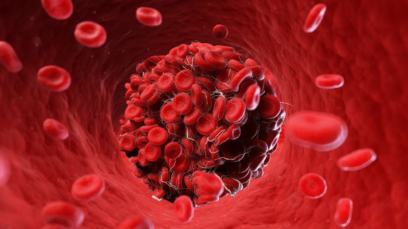 COVID-19 tied to dangerous blood clots in cancer patients