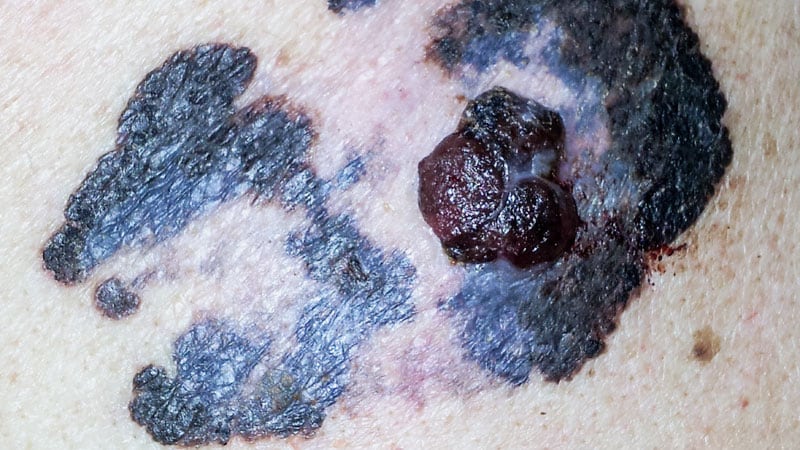 Pembro Earlier than and After Melanoma Surgical procedure Boosts Outcomes