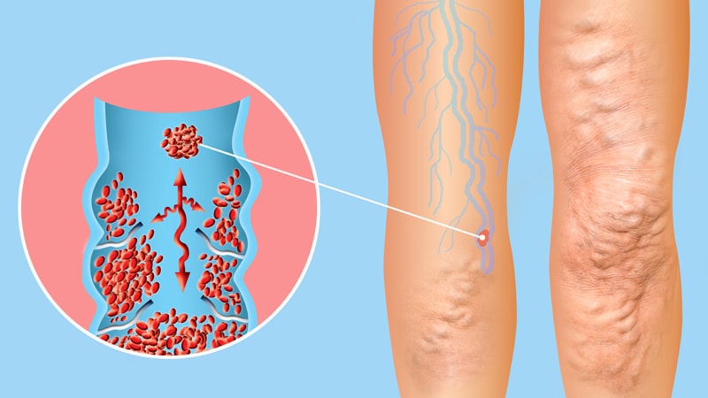 What is DVT? Signs, Symptoms, Causes and Testing - Truffles Vein Specialists