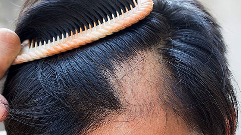 JAK Inhibitor Increases Hair Growth in Alopecia Areata Patients