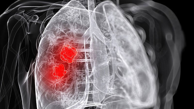 Transplantation pulmonaire chez un patient atteint d’un cancer du poumon en phase terminale
