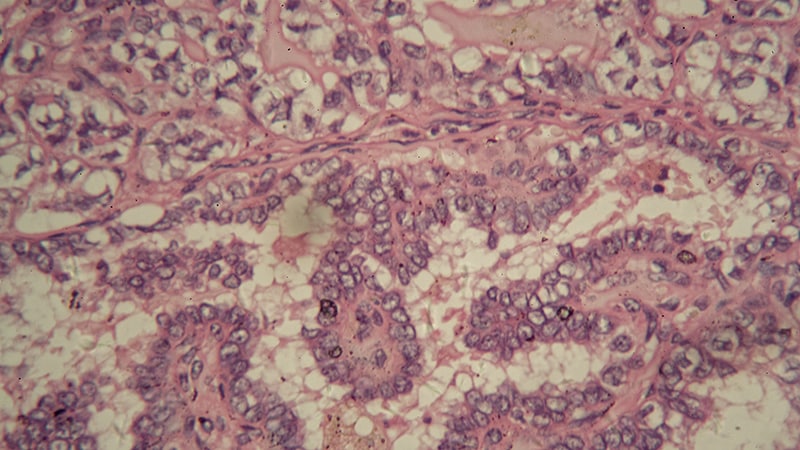 Of Benign Thyroidectomies, 9% Carry Papillary Thyroid Microcarcinomas