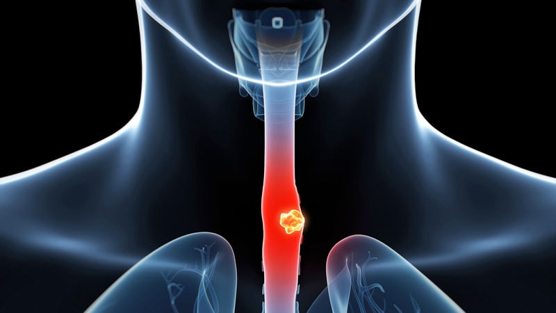 cytosponge-for-detecting-barrett-s-and-esophageal-cancer