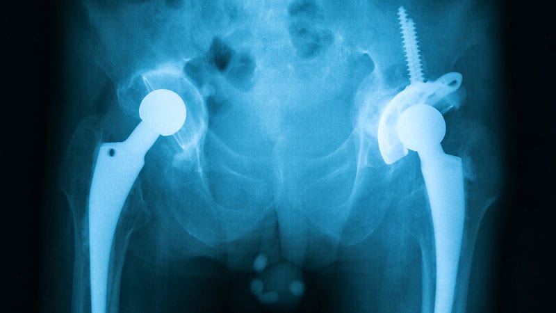 Rapid MRSA Decolonization Beneficial for Emergency Hip Surgery