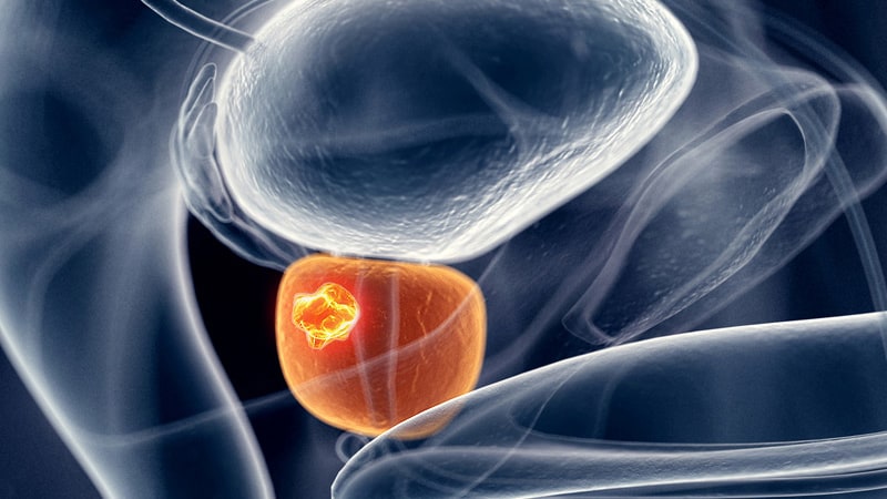 Talazoparib Add-on verbessert die Ergebnisse bei metastasierendem Prostatakrebs