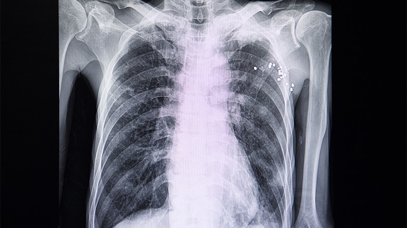 La spirométrie spécifique à la race peut manquer les diagnostics d’emphysème