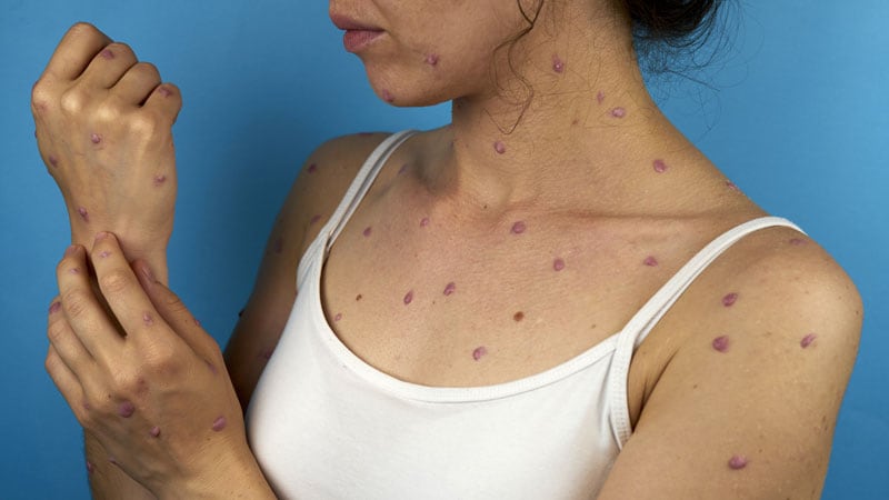 What's monkeypox?' Woman with 'insane rash' turned away for testing