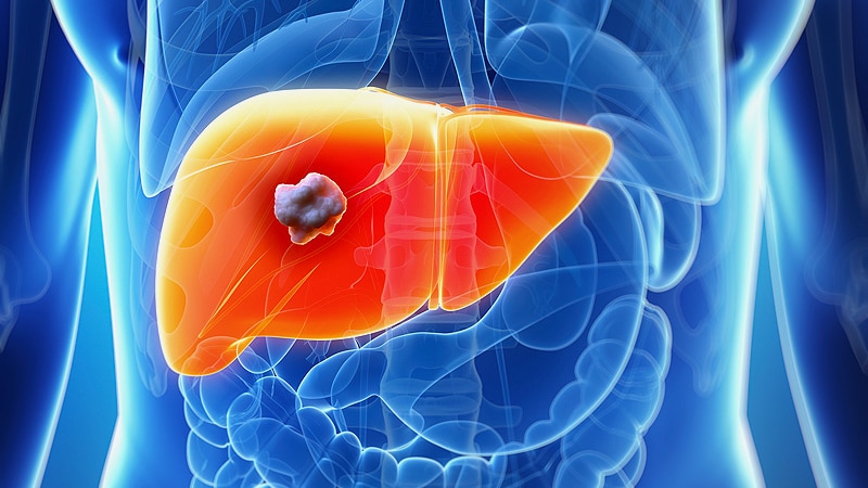 FDA Approves New Immunotherapy Combo for Liver Cancer - Medscape