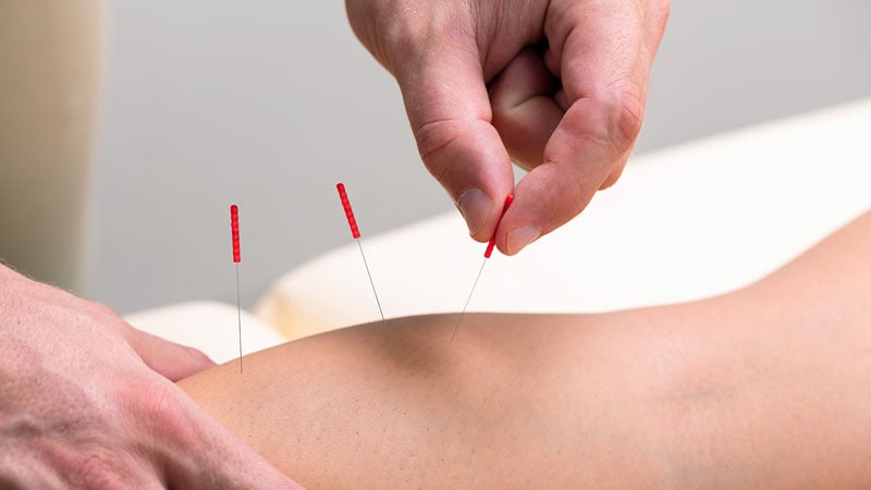 L’acupuncture liée à la réduction des douleurs articulaires jusqu’à un an