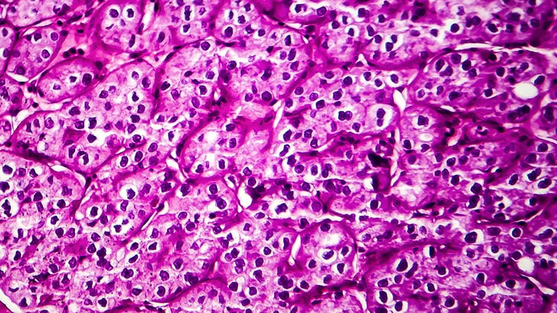 L’atezolizumab ne parvient pas à améliorer les résultats du cancer du rein postopératoire