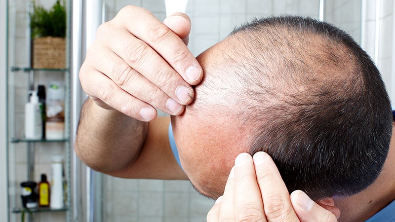 Review Gives Weight to Supplements for Hair Loss