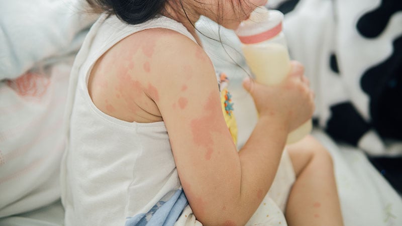 Comment les cliniciens peuvent-ils distinguer l’allergie alimentaire du RGO chez les jeunes enfants ?