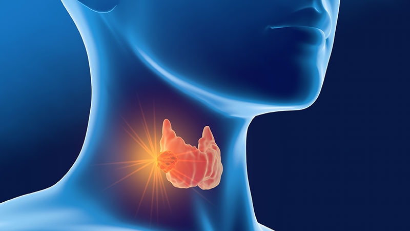 Les choix de mode de vie pourraient réduire le risque génétique de cancer de la thyroïde