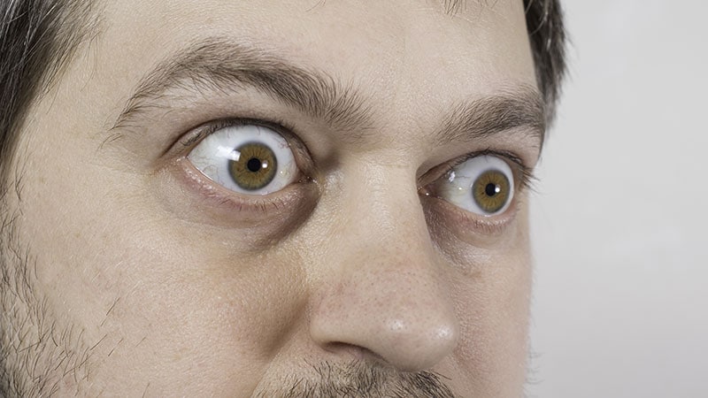 L’IA détecte une maladie oculaire thyroïdienne sévère