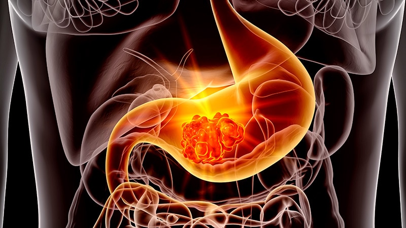 Les variantes génétiques plus H pylori augmentent le risque de cancer gastrique