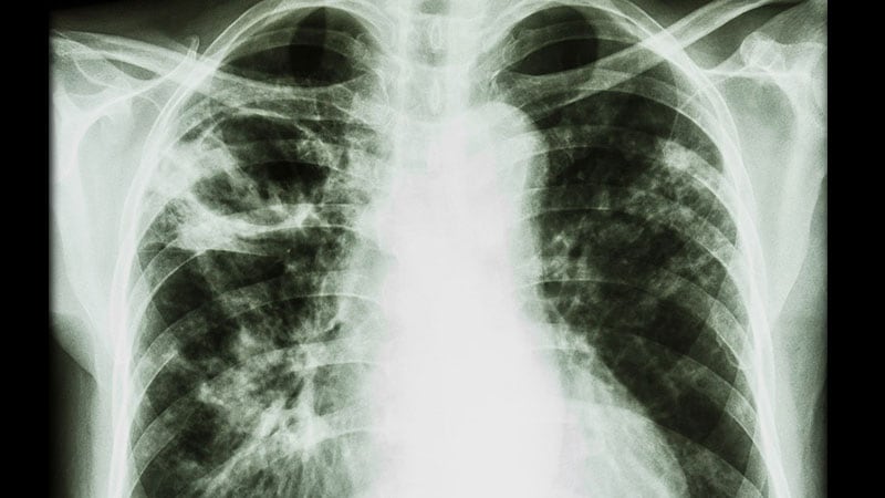 AI Promising in Detecting TB From Chest X-rays