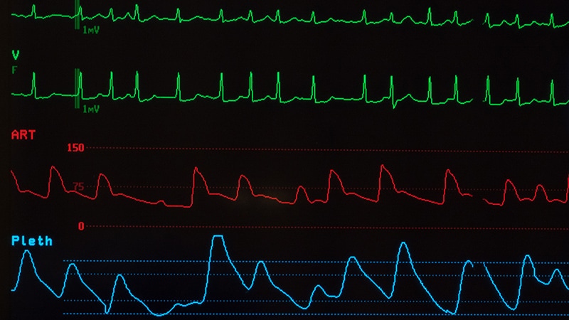 Hybrid Ablation Beats Endocardial Alone for Persistent AF