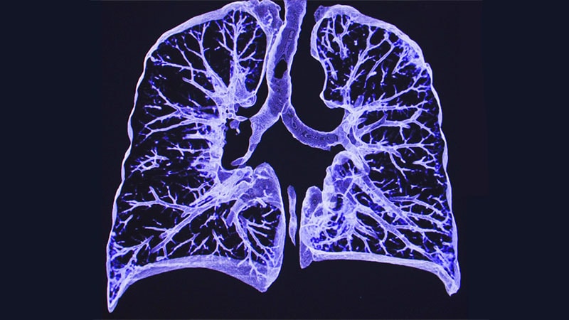 CT Imaging May Help Predict COPD Progression