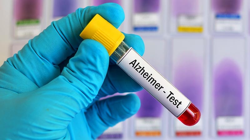 Alzheimer's Blood Test Coming Within 5 Years, UK Pledges