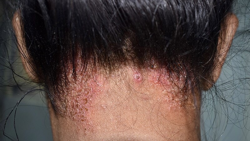 Rapid Review Quiz Adult Tinea Capitis Page 5 4763