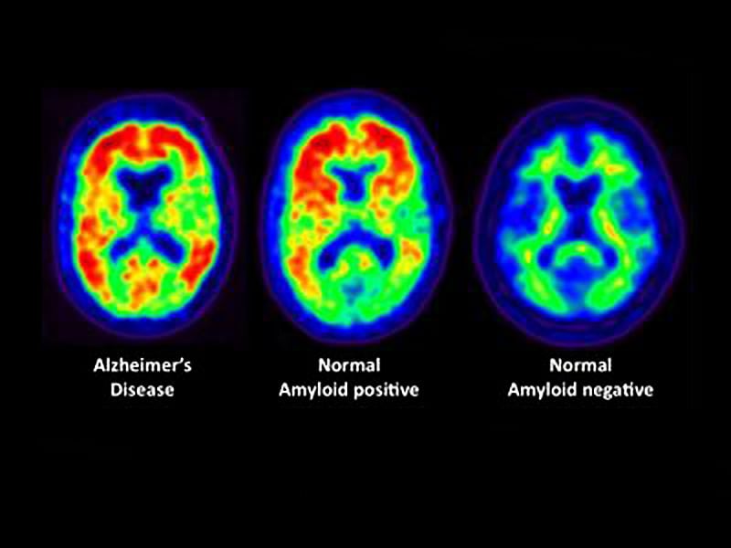 Image result for amyloid brain PET scans